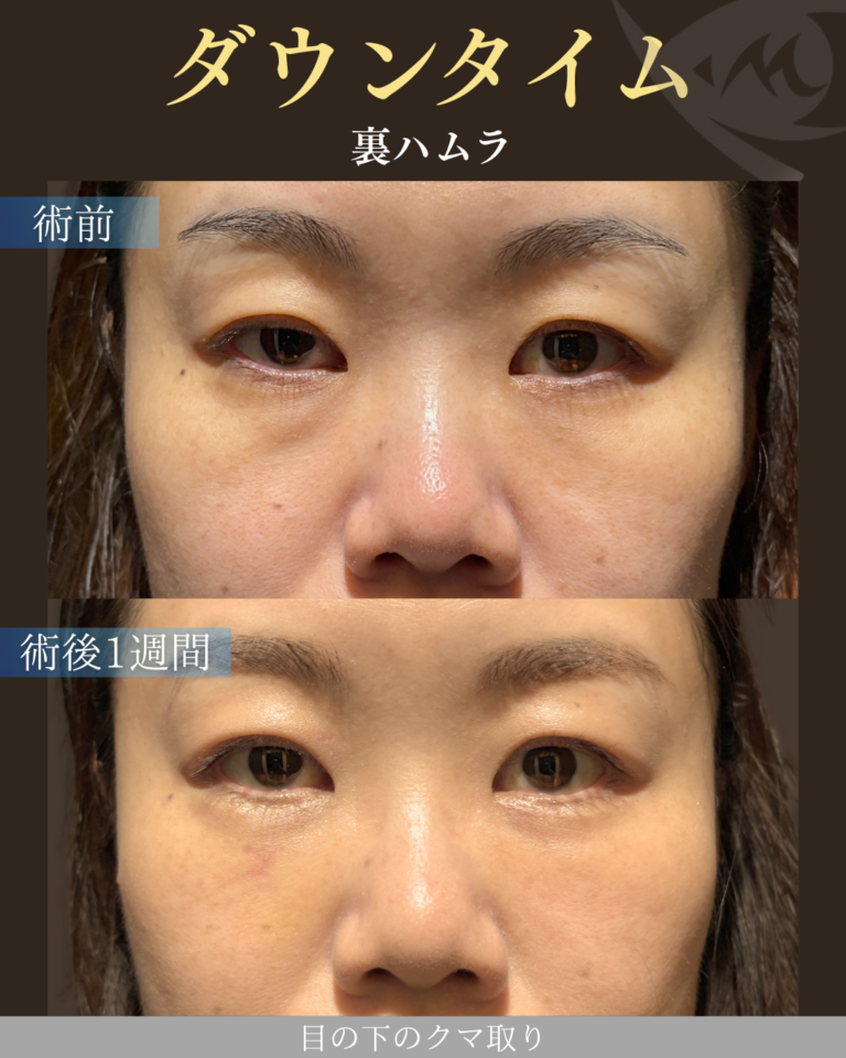 40代女性 裏ハムラ ダウンタイム